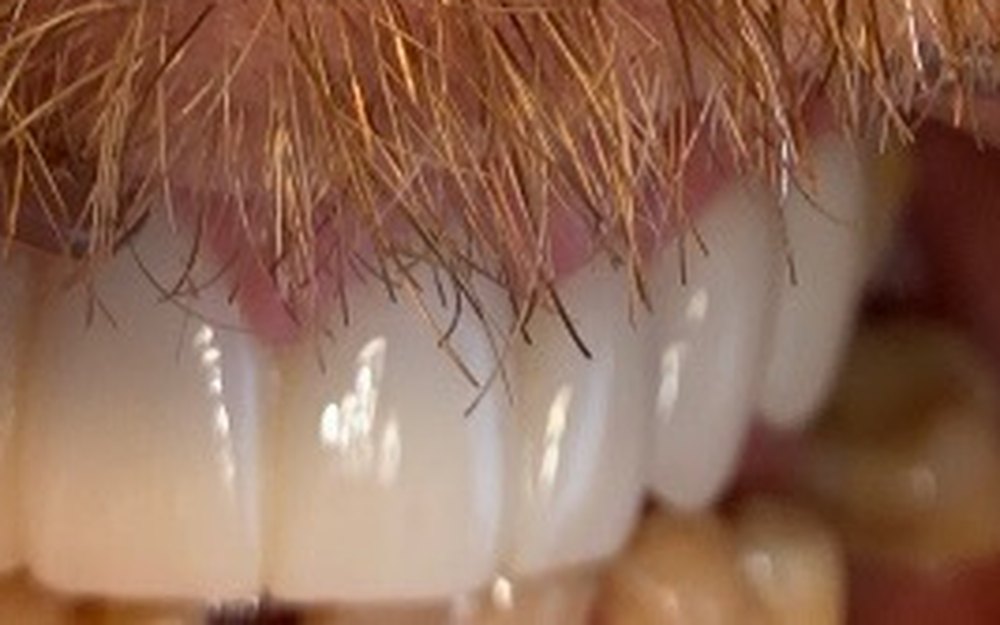 Uśmiech pacjenta po leczeniu protetyczno-implantologicznym — metamorfoza 10